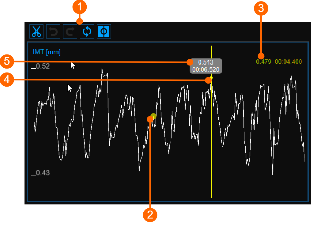 cvs_IMTchart_cineloopReview_gliffy_EN