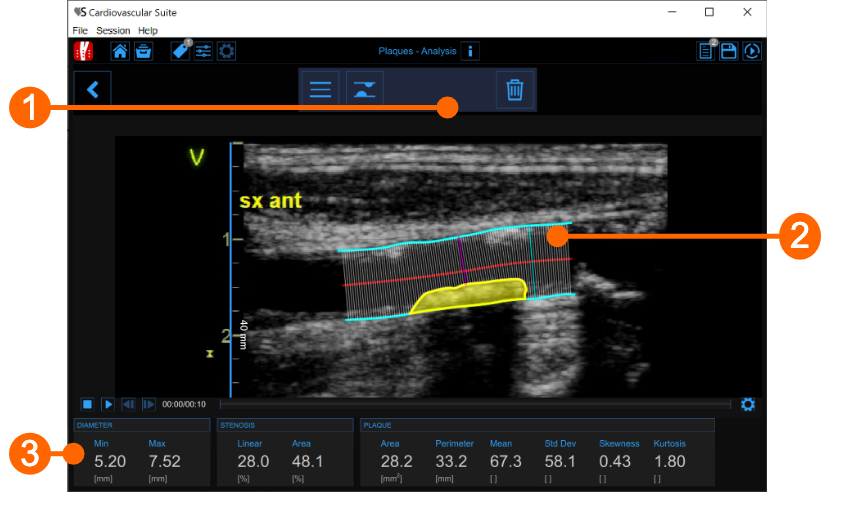 cvs_plaqueAnalysis_singleImage_gliffy_EN