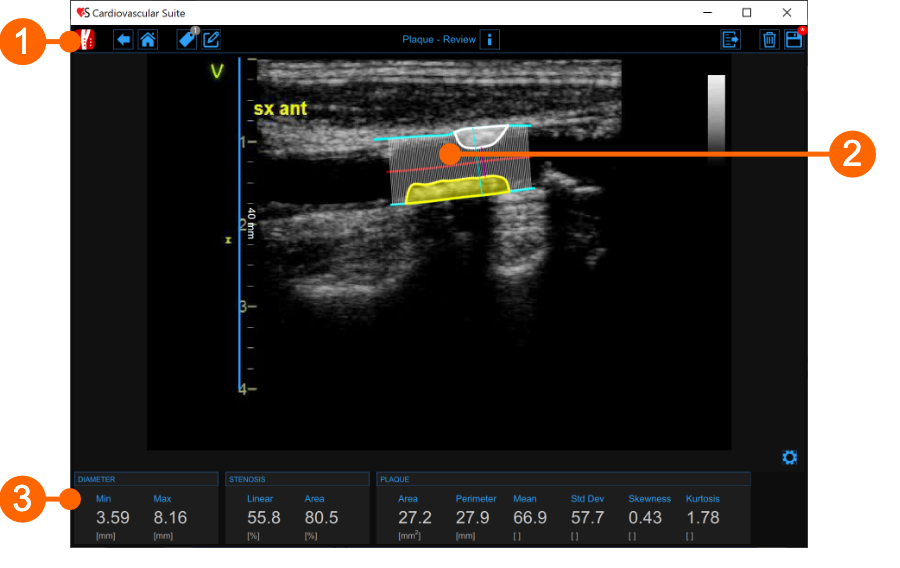 cvs_plaqueReview_gliffy_EN